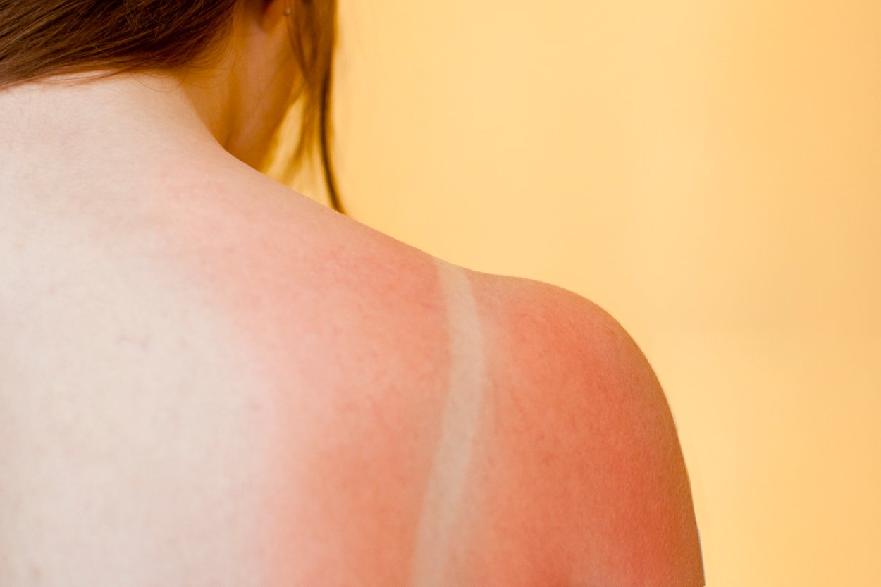 Sonnenbrand auf der Schulter Sonnenbrand auf der Schulter