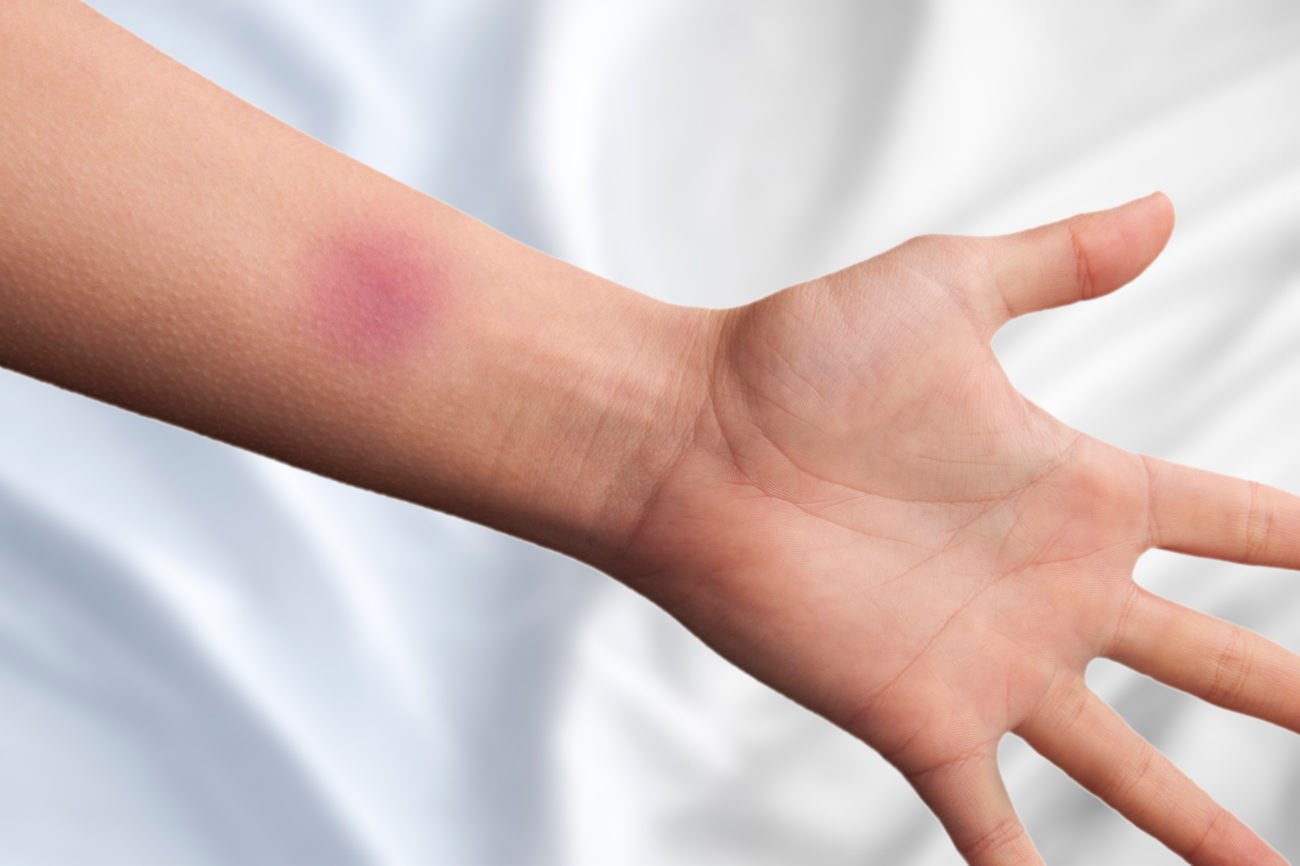 Was hilft gegen blaue Flecken? 9 schnelle Tipps