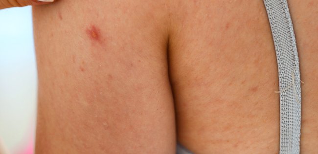 Unreine Haut kommt wahrscheinlich vom überladenen Hormonhaushalt.