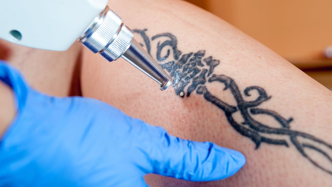 Laser-Tattooentfernung am Bein