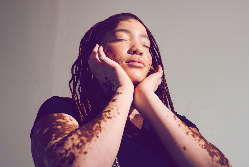 Frau mit Vitiligo stützt ihren Kopf in die Hände