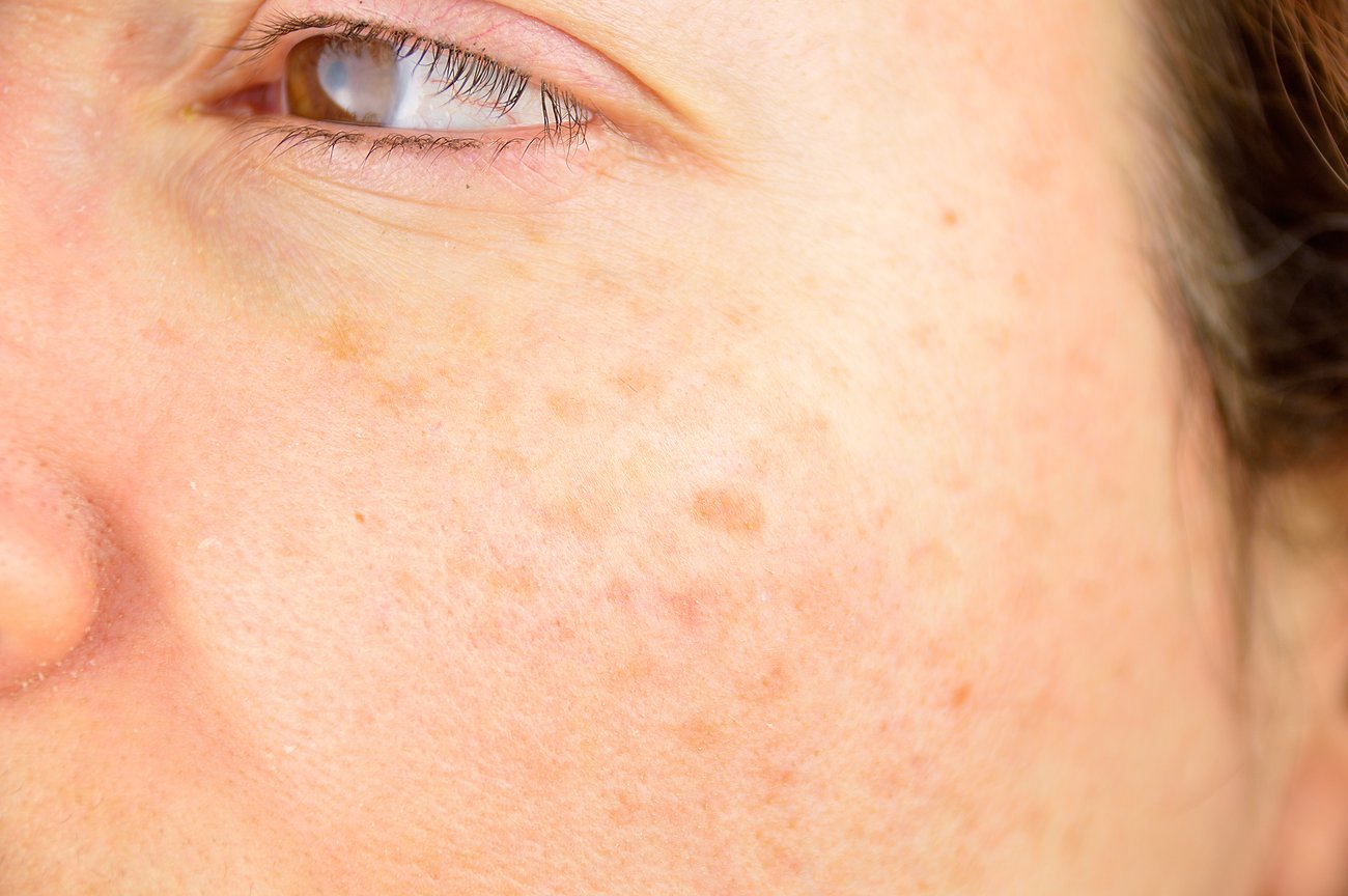 Chloasma loswerden Chloasma loswerden
