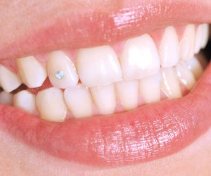 Zahnschmuck: Top 6 Fakten zu Zahnsteinchen