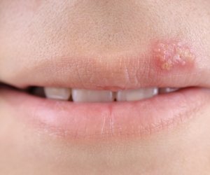 Bei leichtem Herpes können auch Hausmittel helfen: 11 Hausmittel gegen Lippenherpes