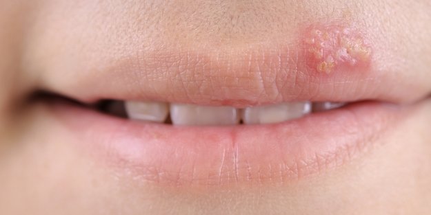 11 wirksame Hausmittel gegen Lippenherpes