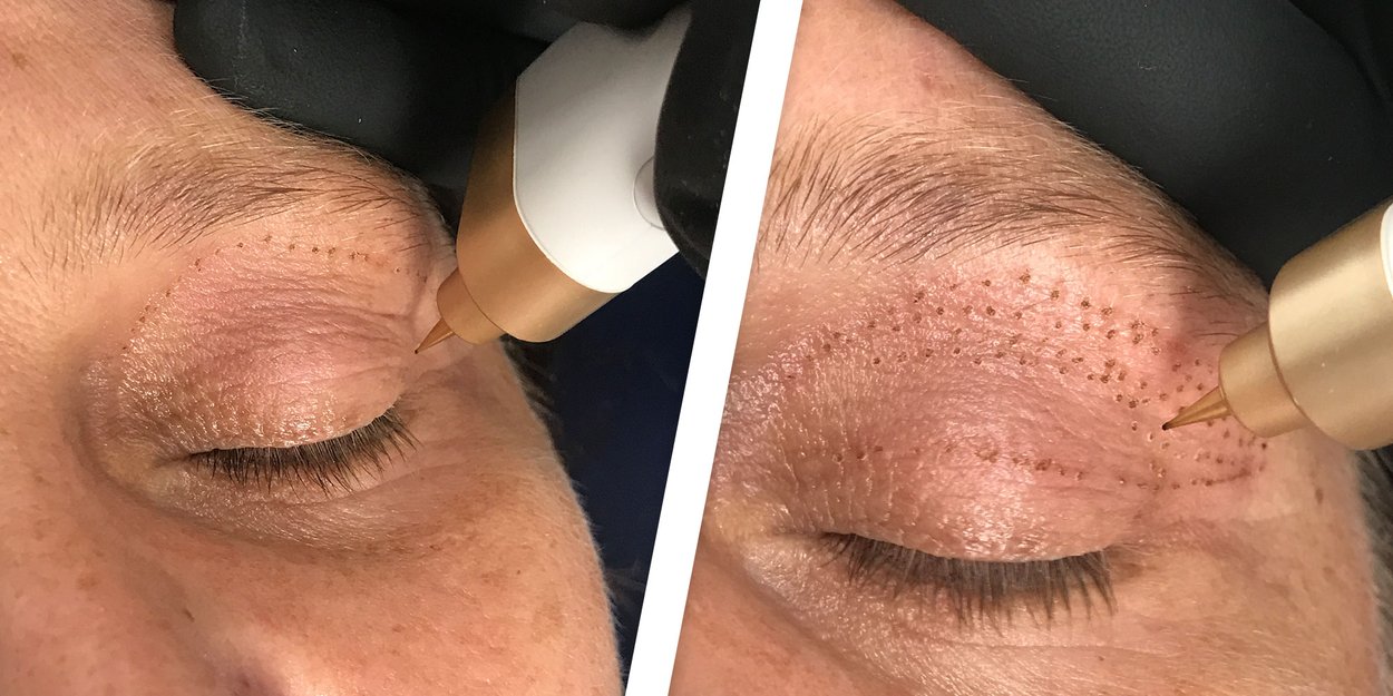 Plasma Pen Behandlung Plasma Pen Behandlung