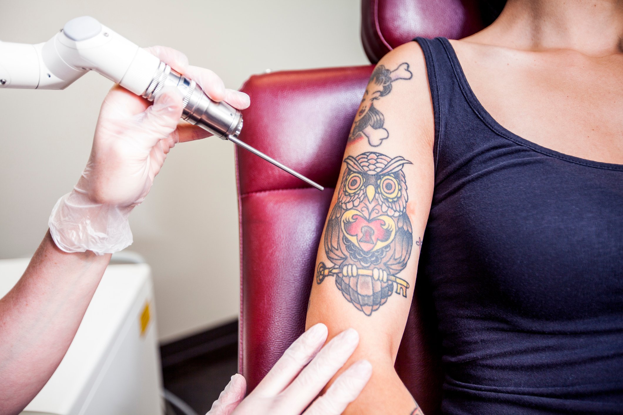 Tattoo entfernen Laserbehandlung