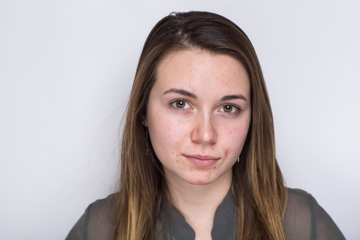 Pickel im Gesicht Pickel im Gesicht