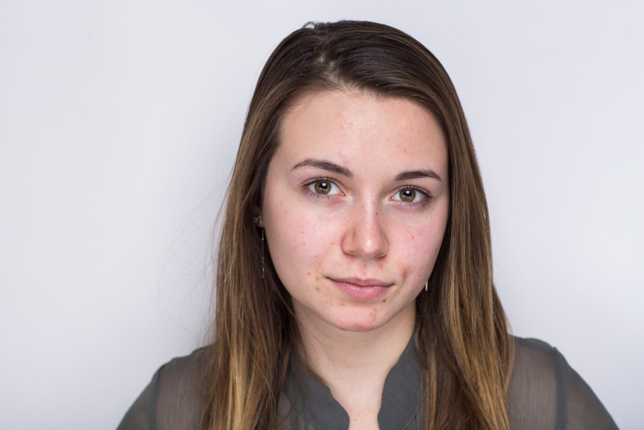Pickel im Gesicht Pickel im Gesicht