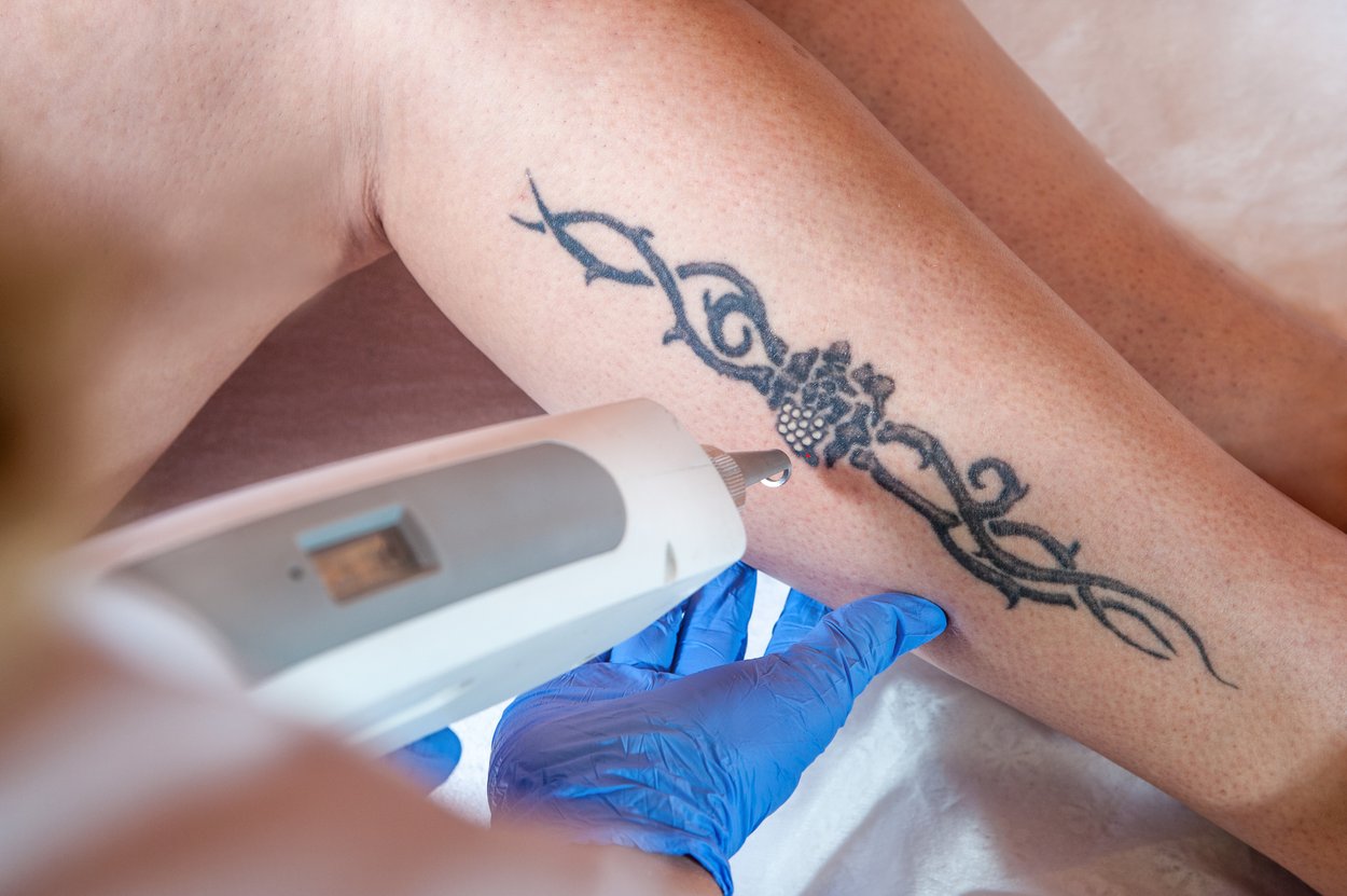Tattooentfernung mit dem Laser Tattooentfernung mit dem Laser