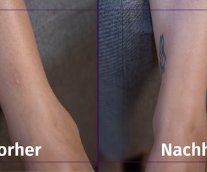 Wie kann ich meine Narben abdecken? - 6 Tipps