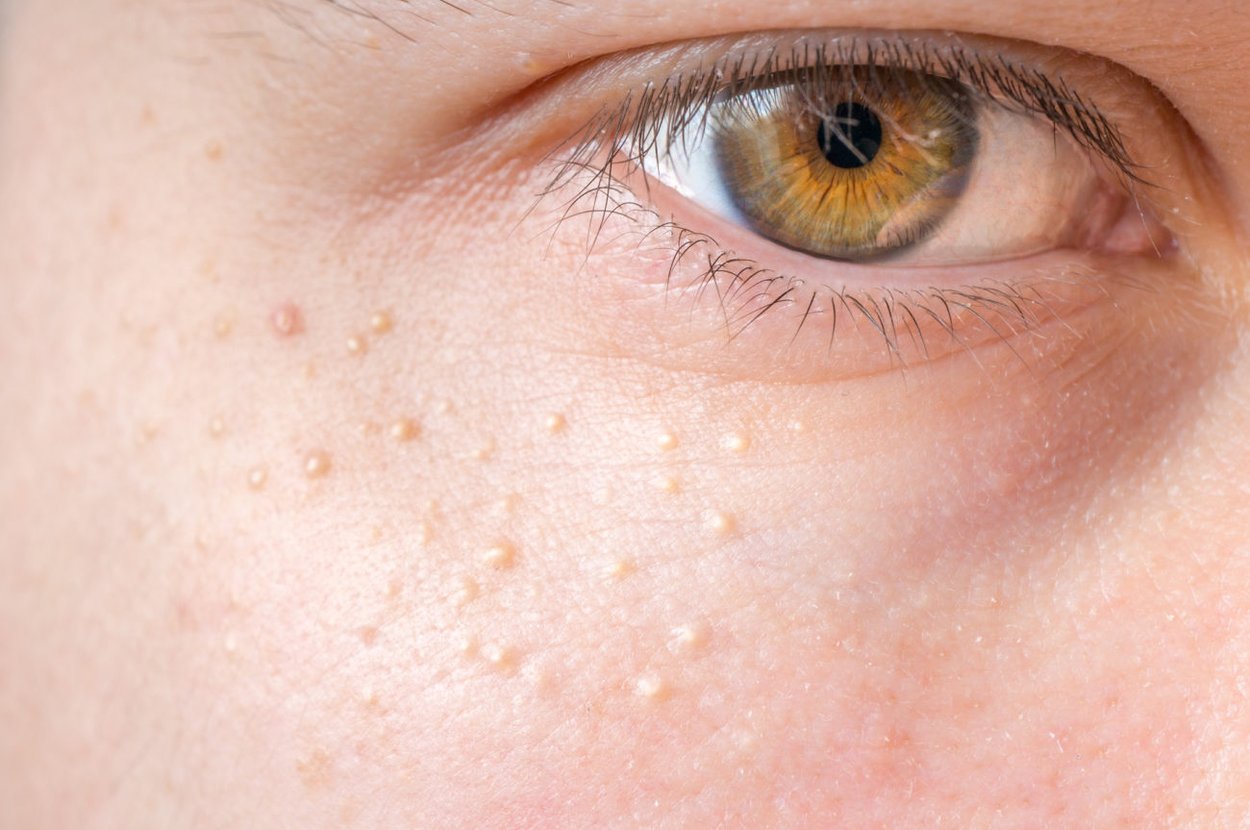 Milien am Auge Milien am Auge
