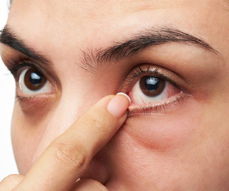 Pickel Am Auge Loswerden Das Hilft Garantiert Desired De