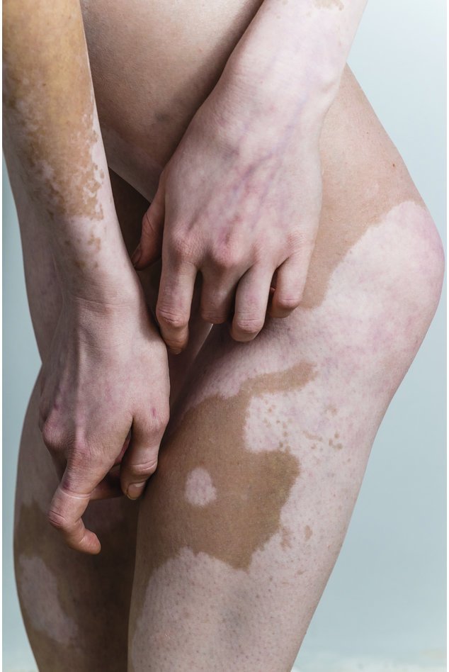 Vitiligo ist nicht gefährlich