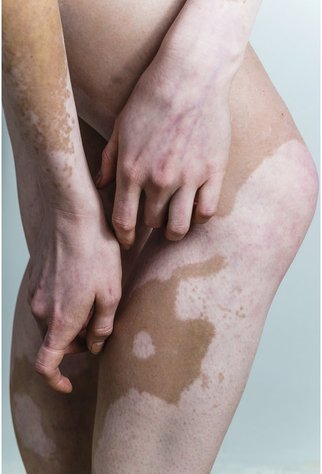 Vitiligo ist nicht gefährlich Vitiligo ist nicht gefährlich