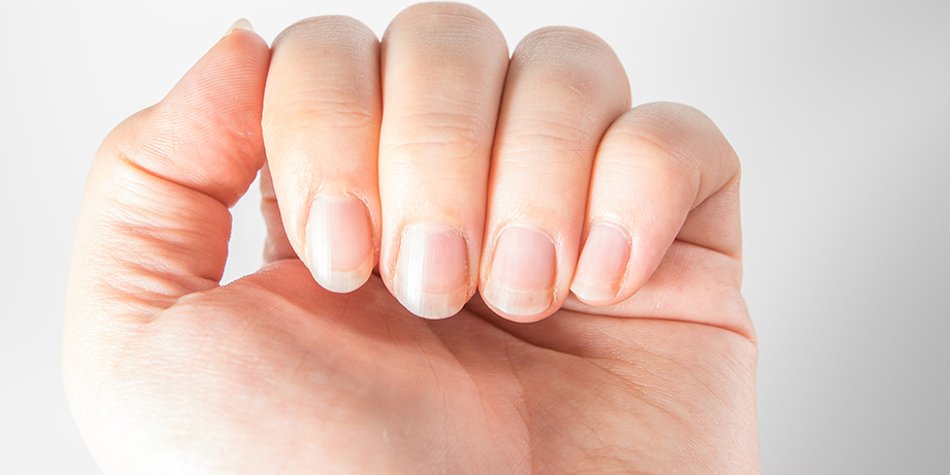 Krankheiten An Den Fingernageln Erkennen Diese 10 Zeichen Sollten Sie Beachten Desired De