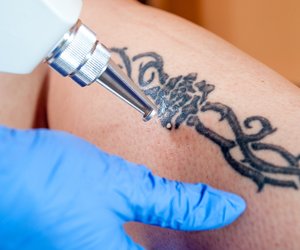Tattoo entfernen: So wirst du deine Tätowierung los