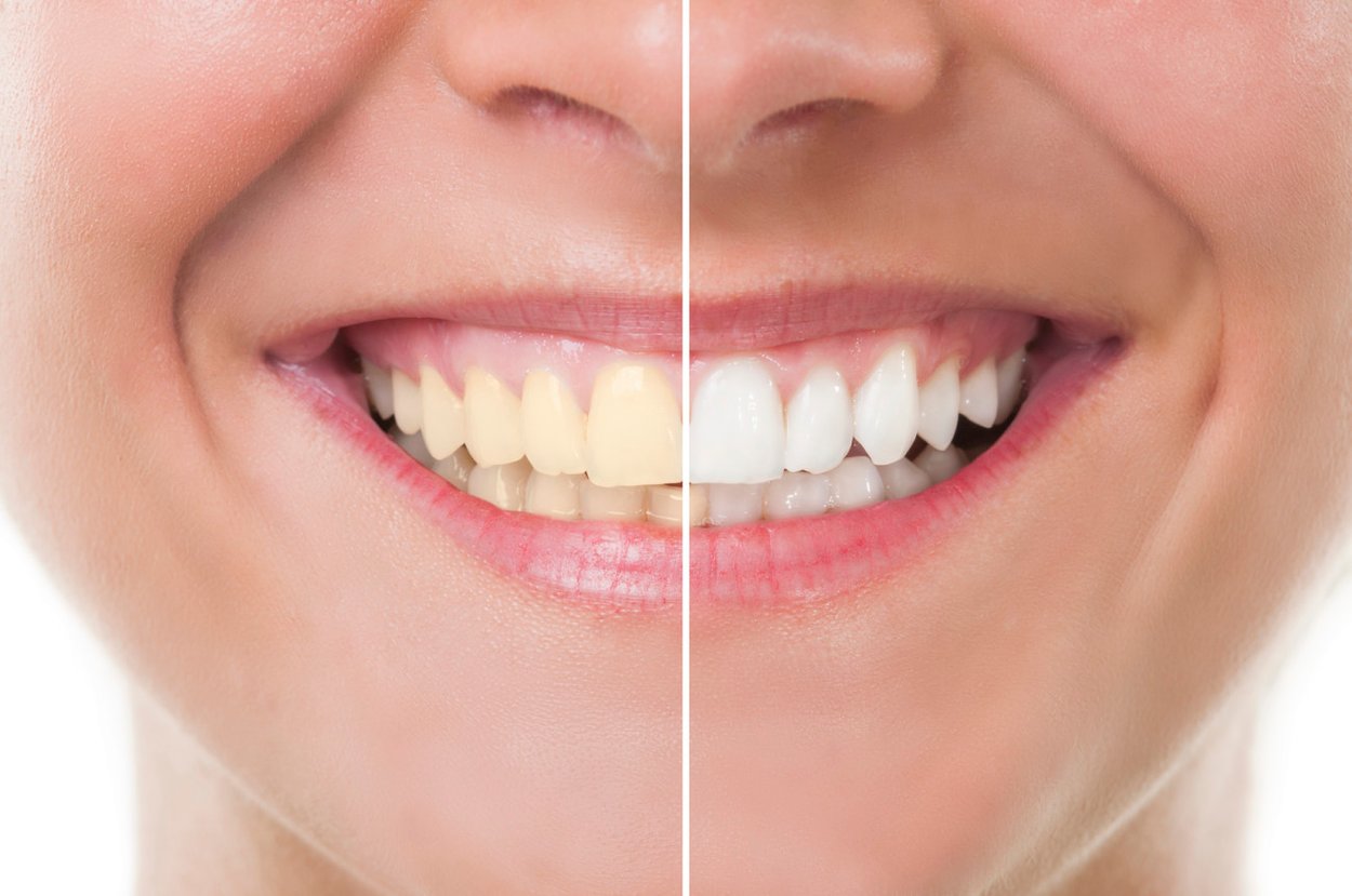 Whitening Pen Erfahrung Whitening Pen Erfahrung