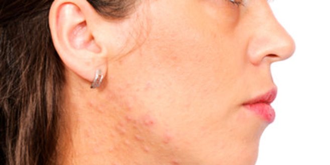 Isotretinoin schädlich Isotretinoin schädlich