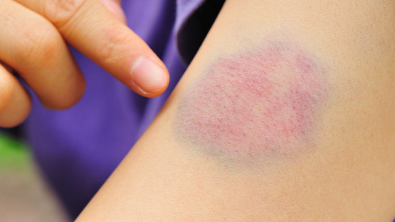 Wie Füge Ich Mir Schnell Blaue Flecken Zu Was hilft gegen blaue Flecken? 9 schnelle Tipps