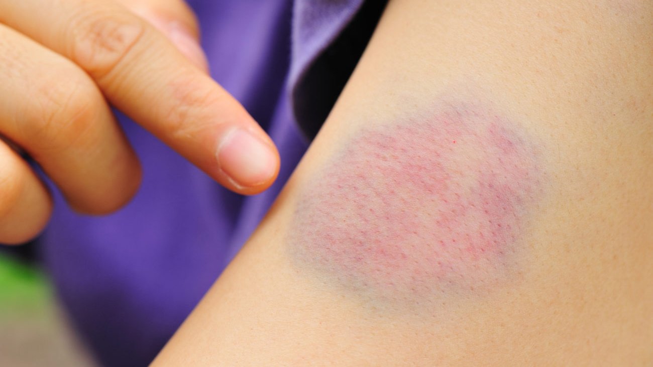 Was hilft gegen blaue Flecken? 9 schnelle Tipps